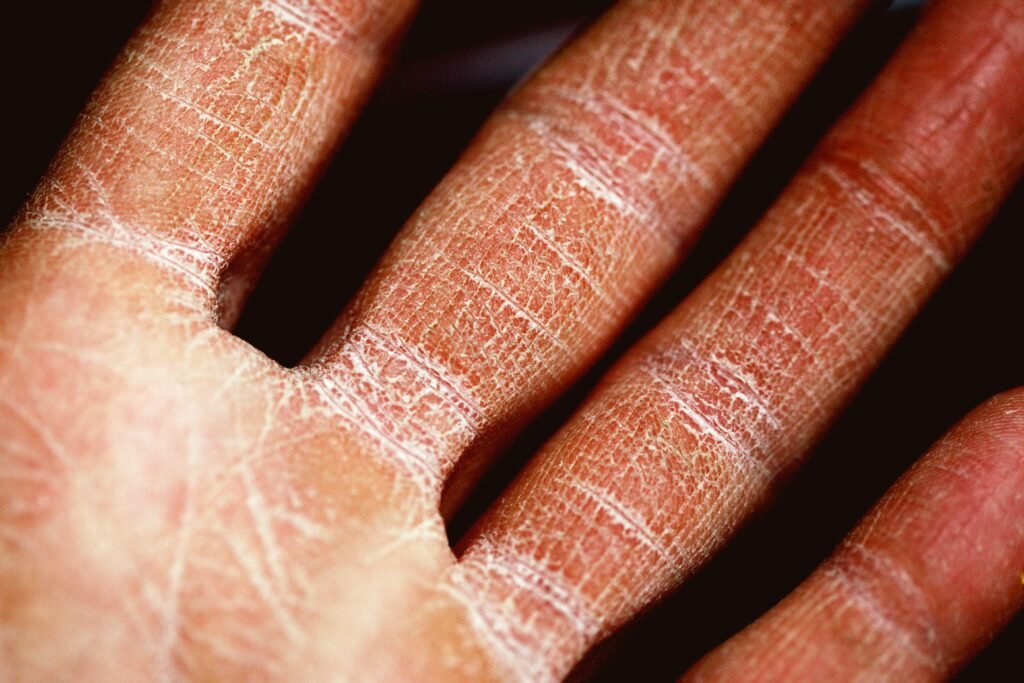 Eczema and Allergies